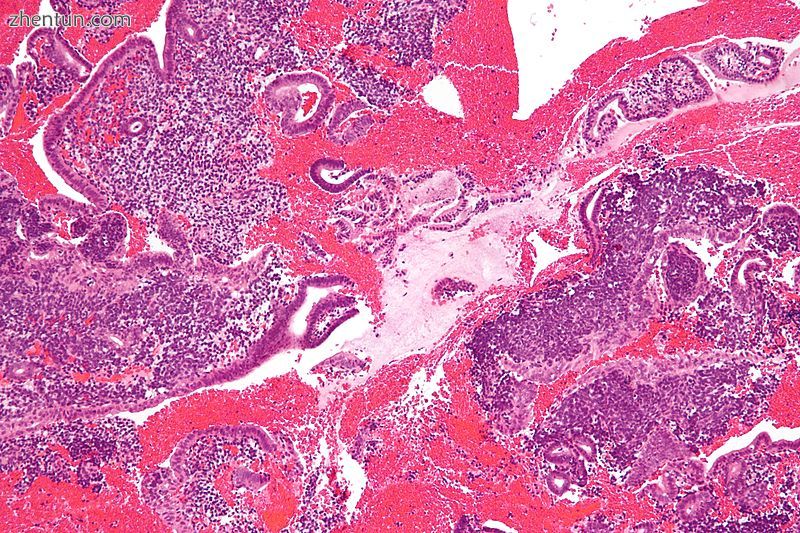Micrograph showing endometrial stromal condensation, a finding seen in menses..jpg