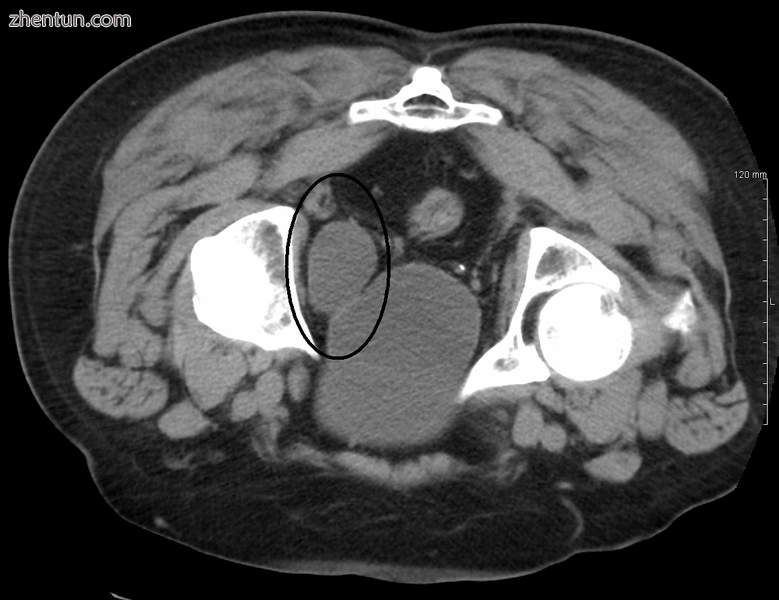 A diverticulum of the bladder.png