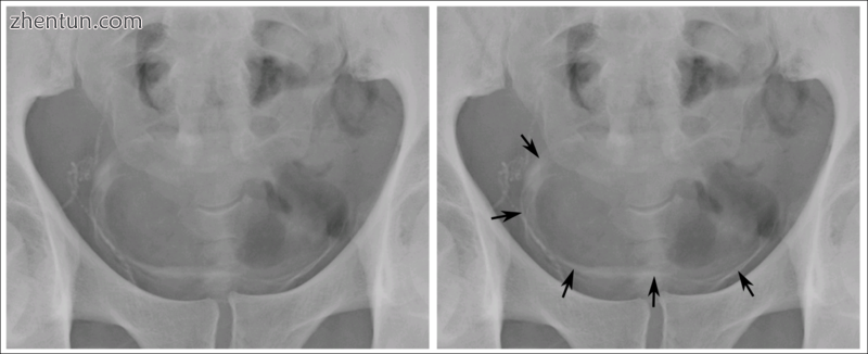 Calcifications on bladder wall caused by urinary schistosomiasis.png