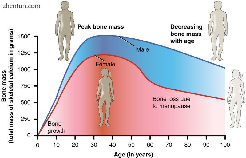 Bone loss due to menopause occurs due to changes in a woman&#039;s hormone levels..jpg