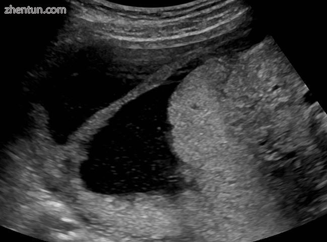 amniotic sheet on ultrasound.jpg