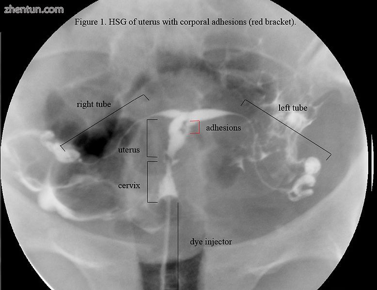 HSG view. Note not the same uterus as in ultrasound or hysteroscopic view; this .jpg
