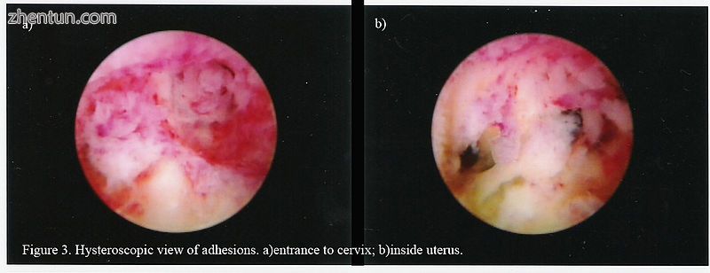 Hysteroscopic view..jpg