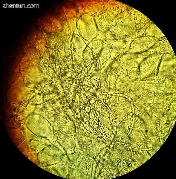 Vaginal wet mount showing the pseudohyphae of Candida albicans surrounded by rou.jpg