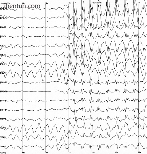 Brain electrical activity recorded from a human patient during an epileptic seizure..png
