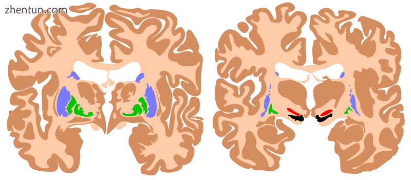 Components of the basal ganglia, shown in two cross-sections of the human brain..png