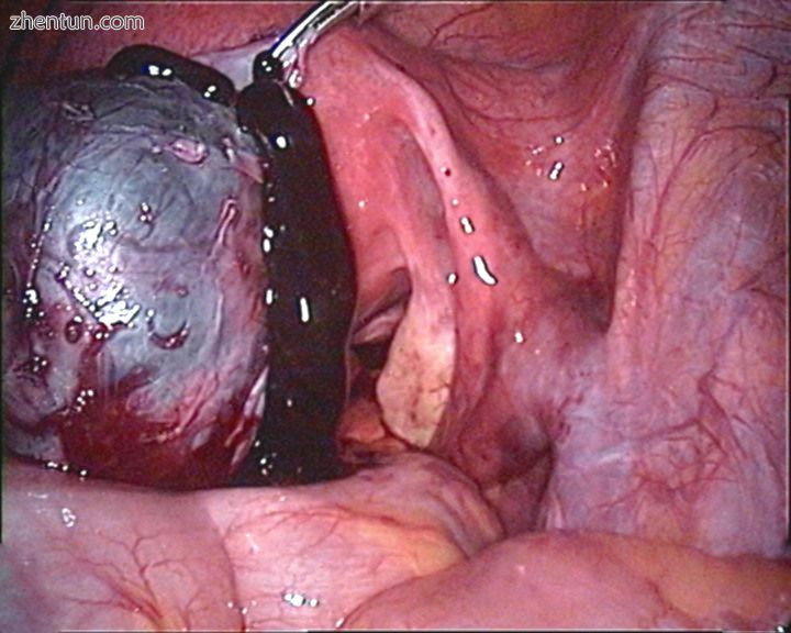 Endoscopic image of a ruptured chocolate cyst in left ovary..jpg