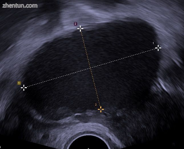 Transvaginal ultrasonography showing a 67 x 40 mm endometrioma as distinguished .jpg