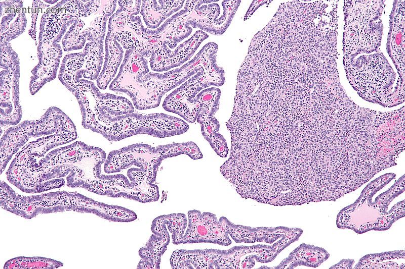 Micrograph of acute and chronic salpingitis. H&amp;E stain..jpg