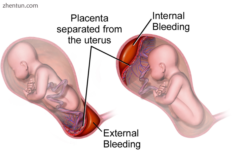 Drawing of internal and external bleeding from placental abruption.png
