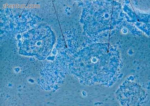 Micrograph of bacterial vaginosis — cells of the cervix covered with rod-shaped.jpg