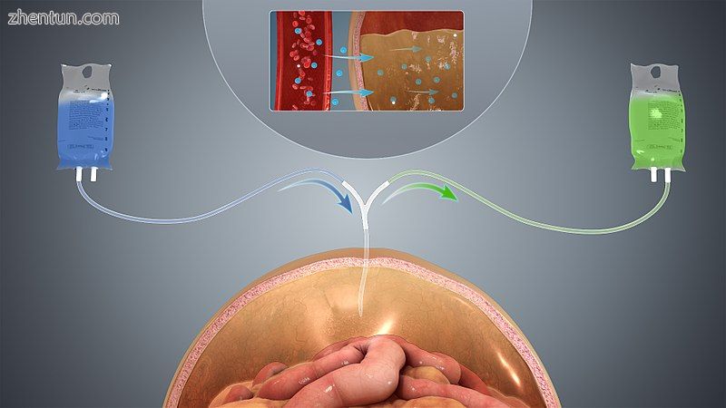 A depiction of Peritoneal dialysis in case of kidney failure..jpg