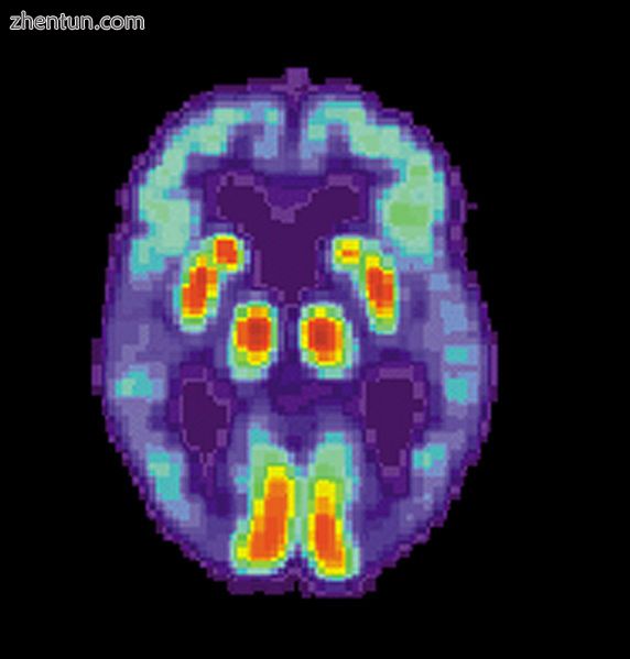 PET scan of the brain of a person with AD showing a loss of function in the temp.jpg