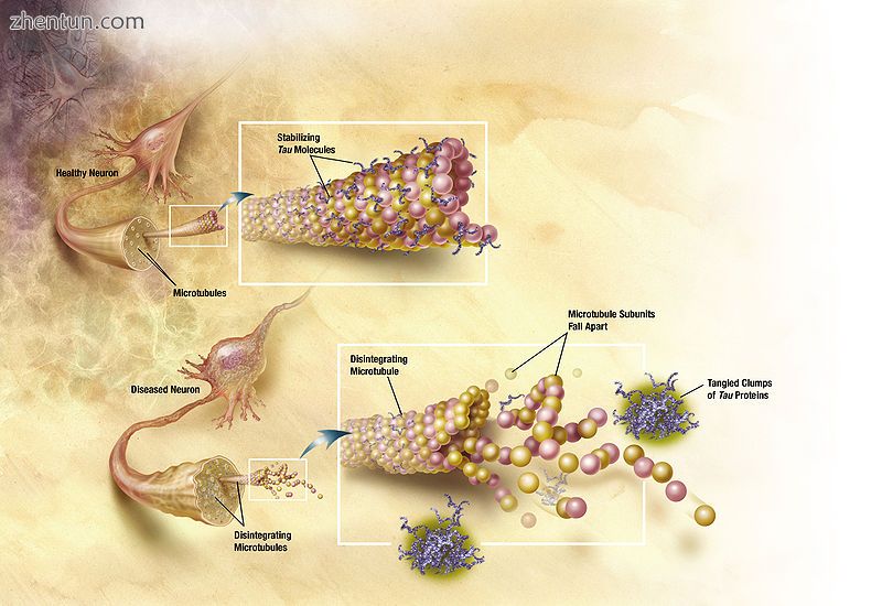 In Alzheimer&#039;s disease, changes in tau protein lead to the disintegration o.jpg