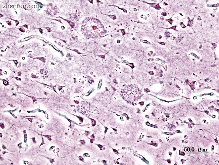 Histopathologic image of senile plaques seen in the cerebral cortex of a person .jpg