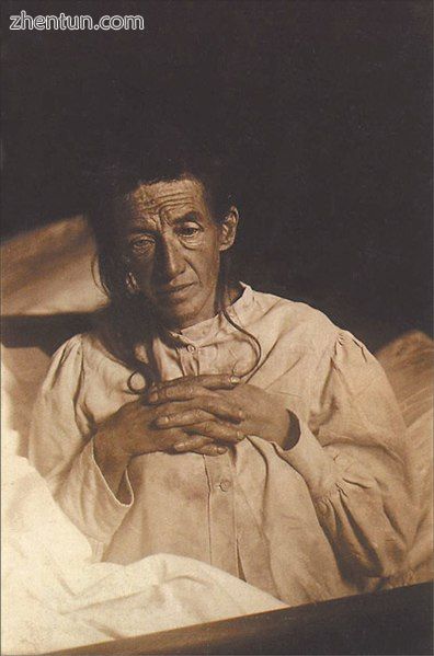 Alois Alzheimer&#039;s patient Auguste Deter in 1902. Hers was the first describ.jpg