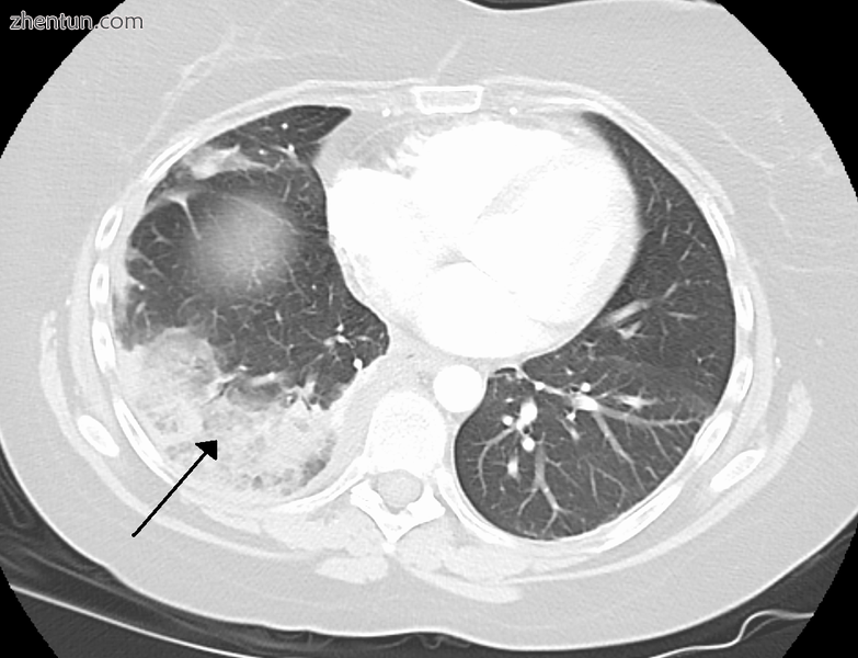 Infarction of the lung due to a pulmonary embolism.PNG