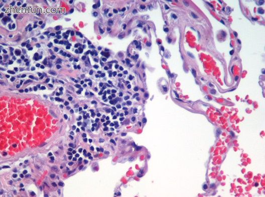 Lung tissue affected by emphysema using H&amp;E stain.jpg