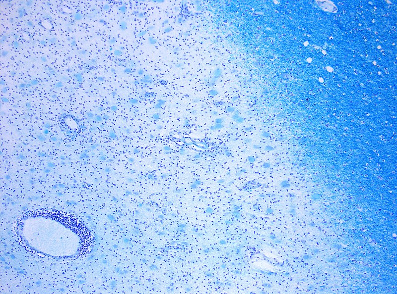 Demyelination in MS. On Klüver-Barrera myelin staining, decoloration in the are.jpg