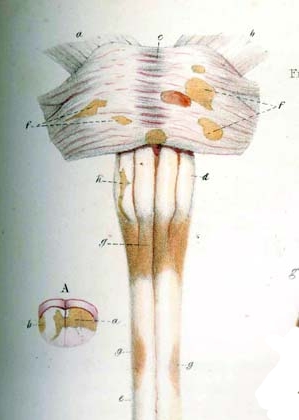 Detail of Carswell&#039;s drawing of MS lesions in the brain stem and spinal cor.jpg