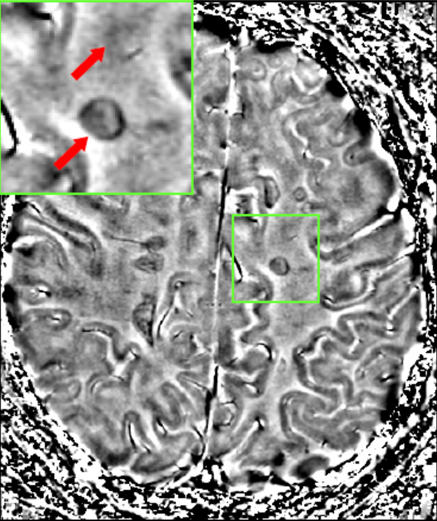 MRI brain scan produced using a Gradient-echo phase sequence showing an iron dep.png