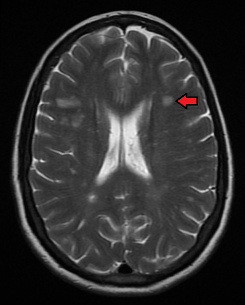 Multiple sclerosis as seen on MRI.png