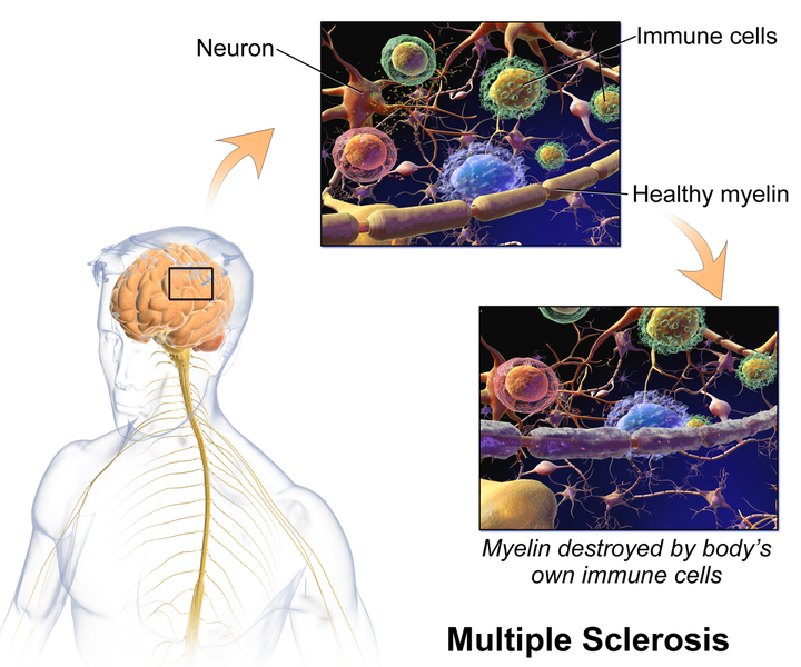 Multiple sclerosis.png