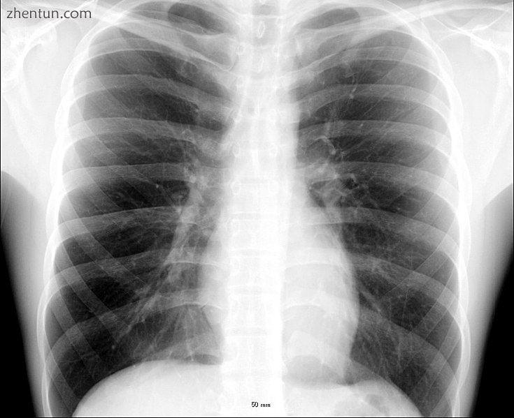 X-ray image of the chest showing the internal anatomy of the rib cage, lungs and.jpg