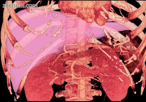 Volume rendering image created with computed tomography, which can be used to ev.jpg