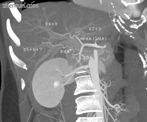 CT scan performed for evaluation of a potential do.jpg