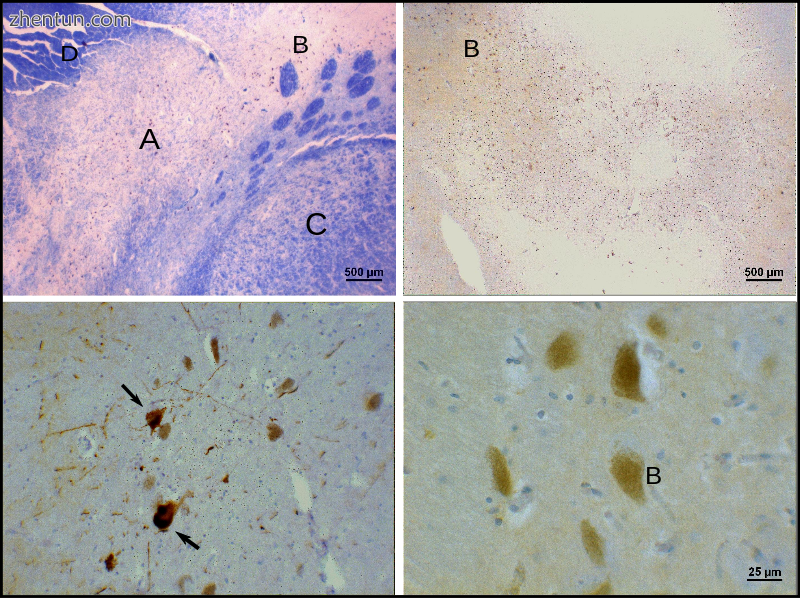 Substantia nigra with loss of cells and Lewy body pathology.png