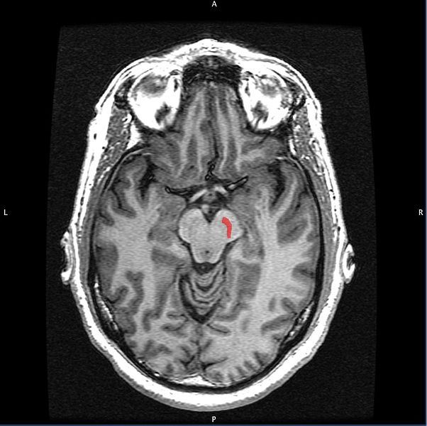 Horizontal MRI (T1 weighted) slice with highlighting indicating location of the .jpg