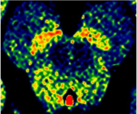 Enhanced Neuromelanin MRI with Color images (RGB) showing Substantia nigra pars .jpg