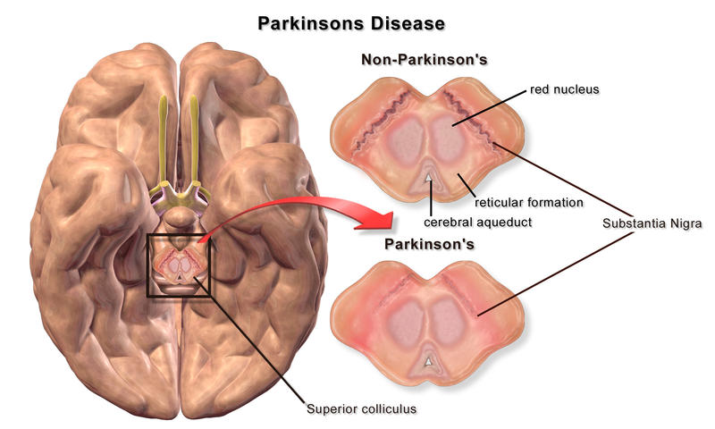Degradation of substantia nigra associated with Parkinson&#039;s disease..png