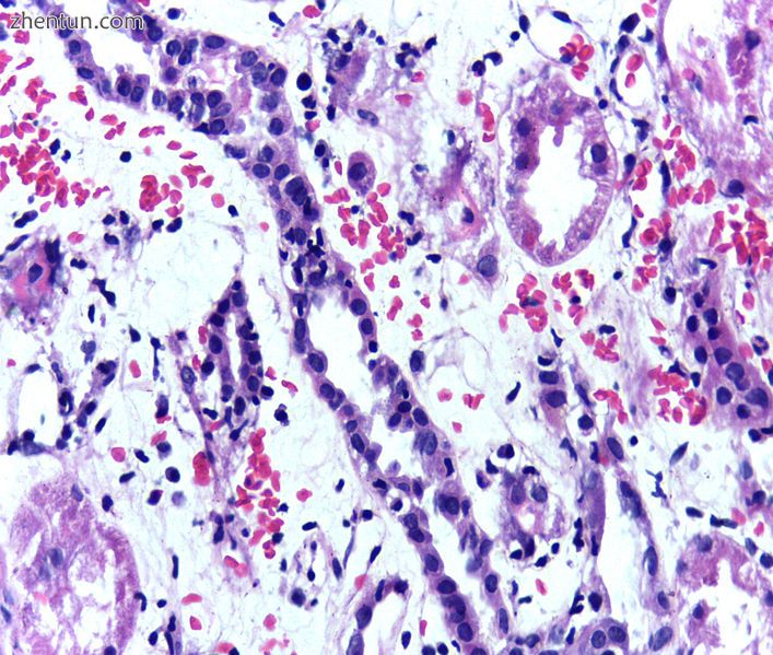 Presence of lymphocytes within the tubular epithelium, attesting to acute cellul.jpg
