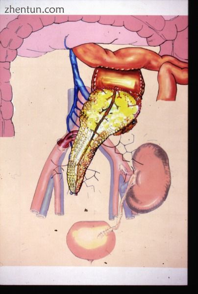 Kidney-pancreas transplant.jpg