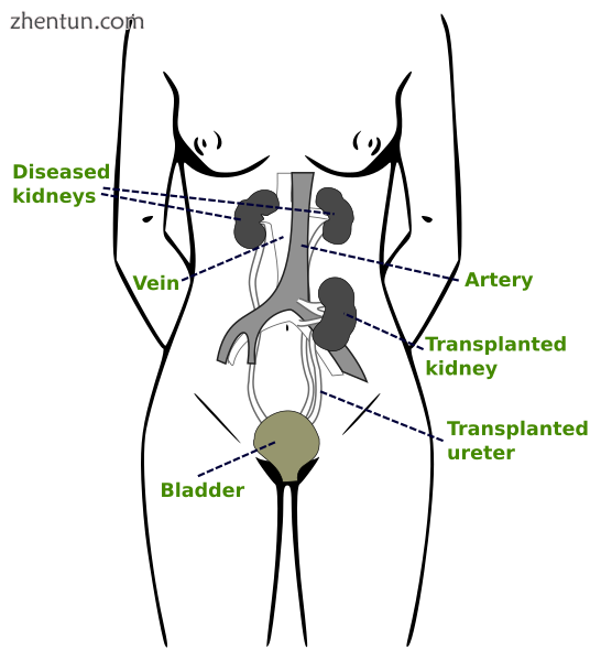 Kidney transplantation.png