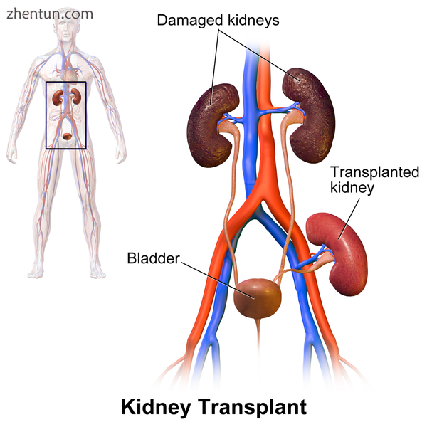 Kidney transplant.png