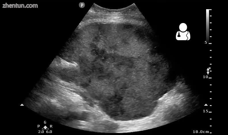 4Postoperative bleeding following kidney transplant as seen on ultrasound[53].jpg