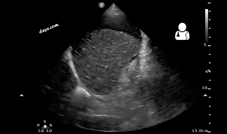 3Postoperative bleeding following kidney transplant as seen on ultrasound[53].gif