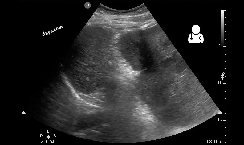 2Postoperative bleeding following kidney transplant as seen on ultrasound[53].gif