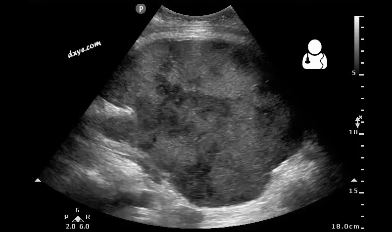 1Postoperative bleeding following kidney transplant as seen on ultrasound[53].gif