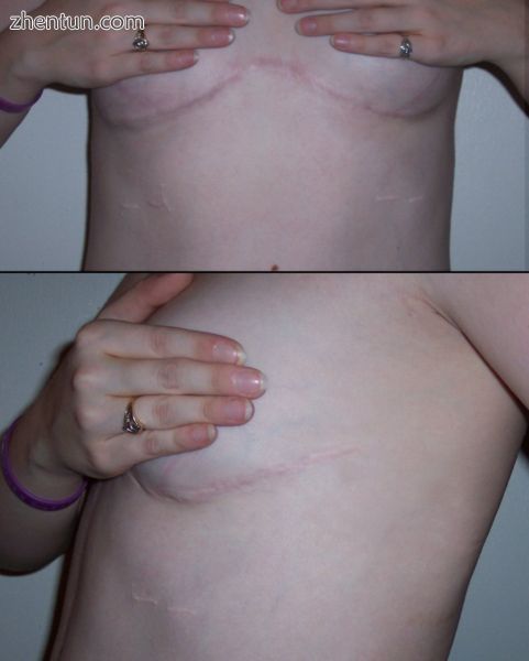 Incision scarring from a double lung transplant.jpg