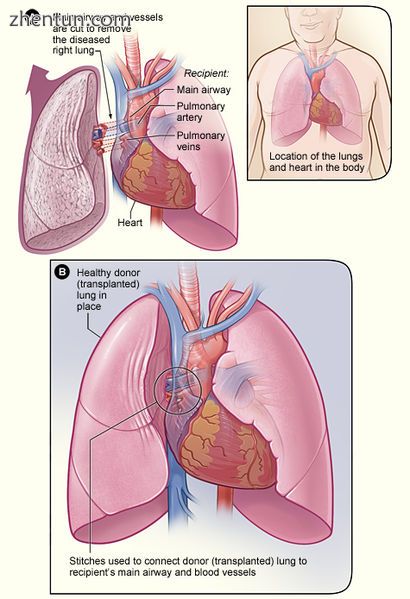 Illustration showing the process of a lung transplant..jpg