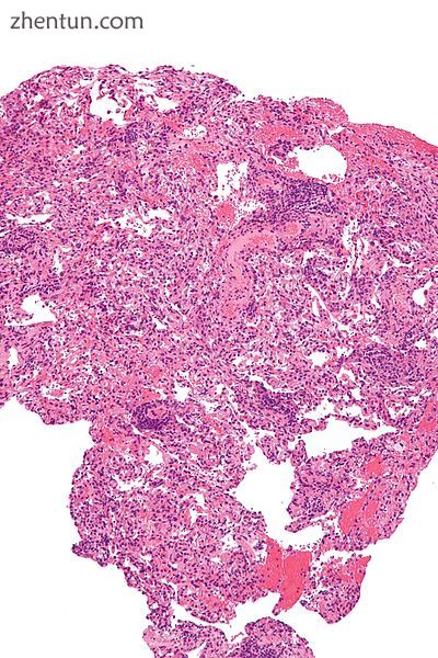 Micrograph showing lung transplant rejection. Lung biopsy. H&amp;E stain..jpg