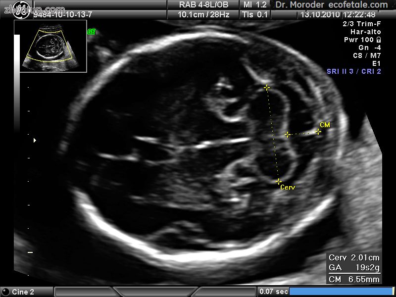 Ultrasound image of the fetal head at 19 weeks of pregnancy in a modified axial .jpg