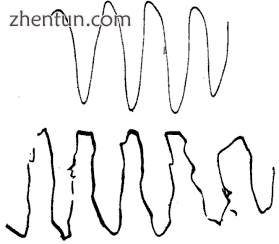 The lower trace shows an attempt by a patient with cerebellar disease to reprodu.png