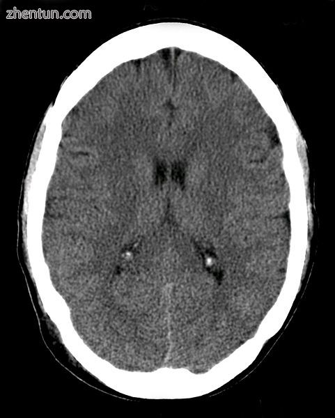 Head CT scan (transverse plane) slice -– a modern application of medical radiography.jpg