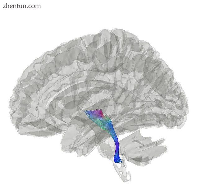 Tractography showing medial lemniscus.jpg