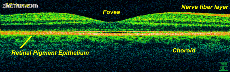 Time-Domain OCT of the macular area of.png